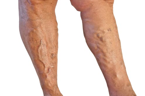 I've got varicose veins. What can I do about them?