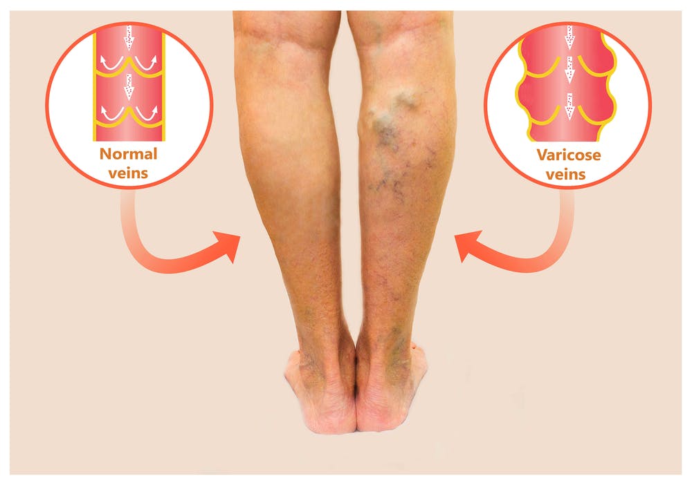 I've got varicose veins. What can I do about them?
