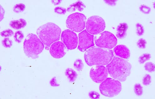 Get Acute Myeloid Leukaemia Researchers Zero In On Treatment Options For Free Get Wallpaper Acute Myeloid Leukaemia Researchers Zero In On Treatment Options For iPhone Free