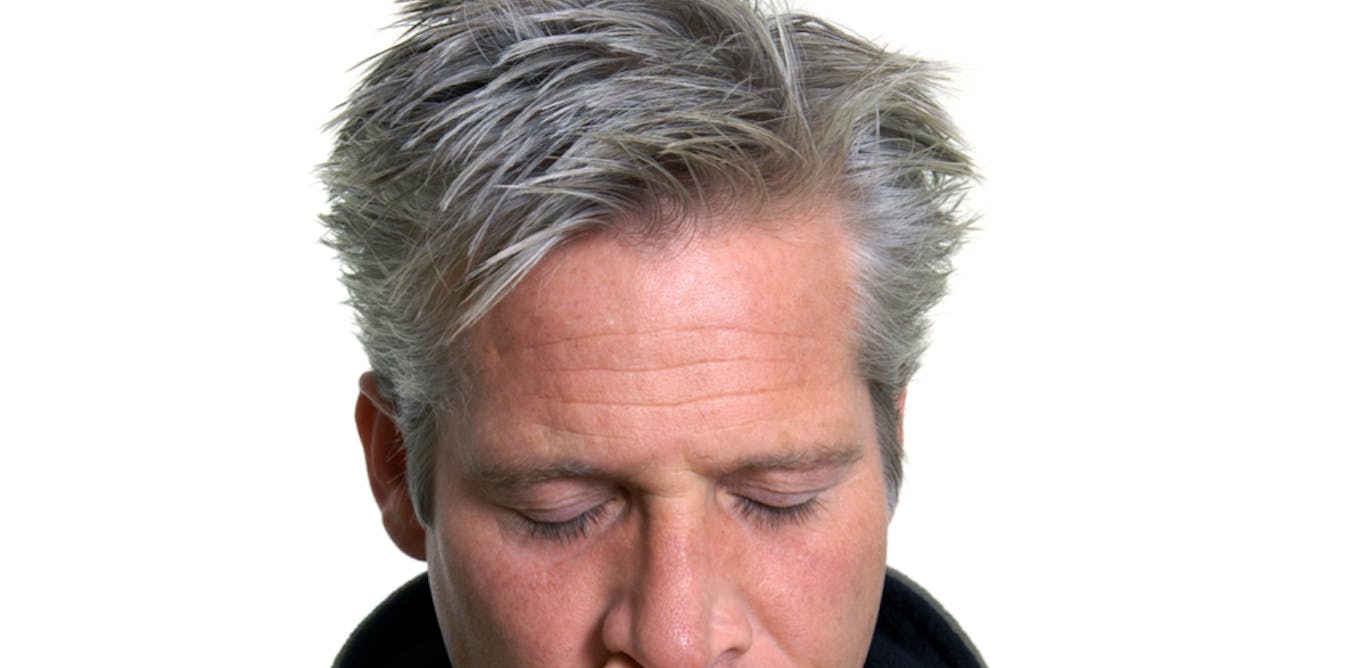 Premature Greying Or Balding May Be Better Predictors Of Heart Premature Greying Or Balding May Be Better Predictors Of Heart