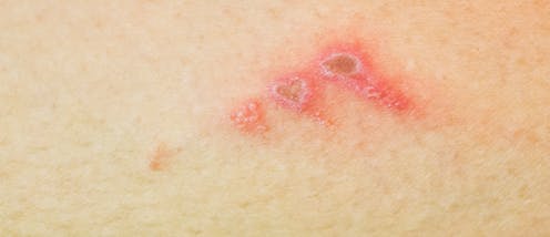 What are school sores and how do you get rid of them?