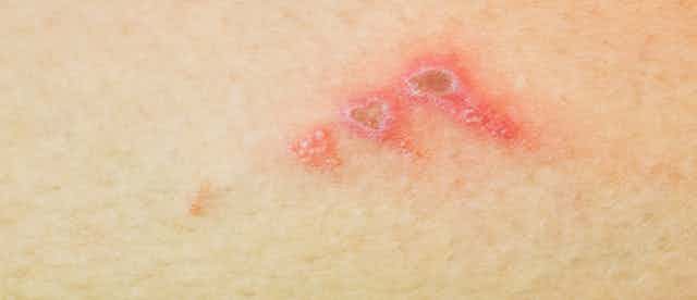 What are school sores and how do you get rid of them?