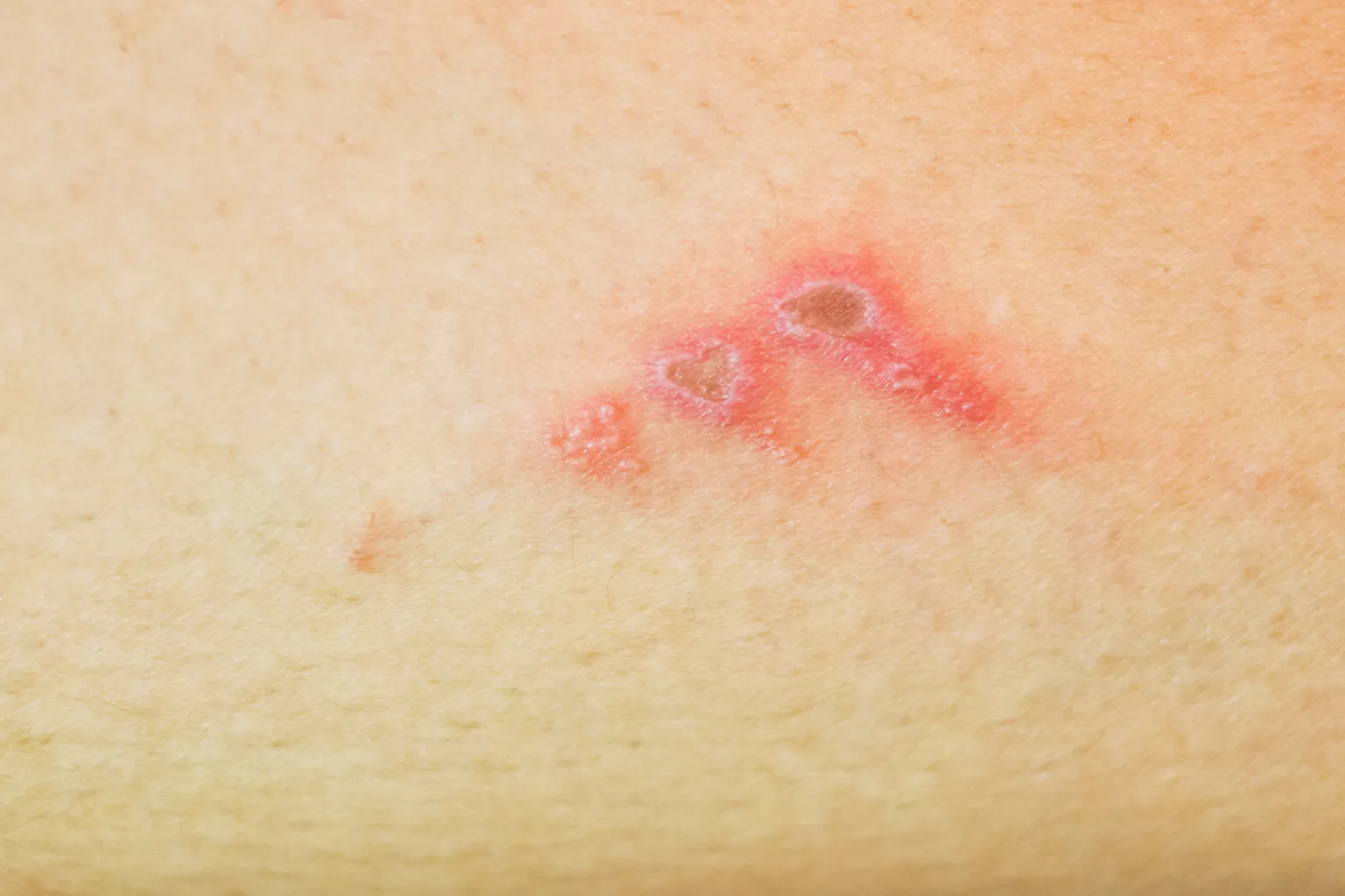Sores Rotten What are school sores and how do you get rid of them?