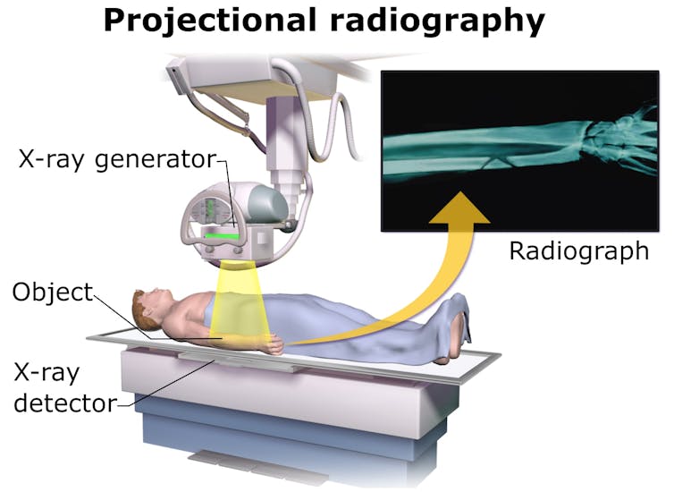 A radiograph of a person’s arm, showing the x-ray source (the generator), the object (the man’s arm) and the detectors. - Wikimedia