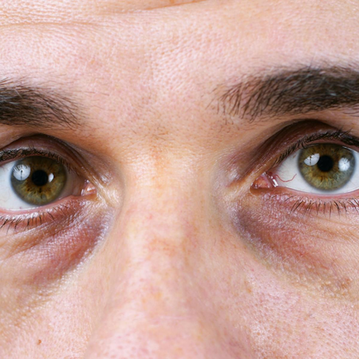 I've always wondered: why do we get dark circles under our eyes?