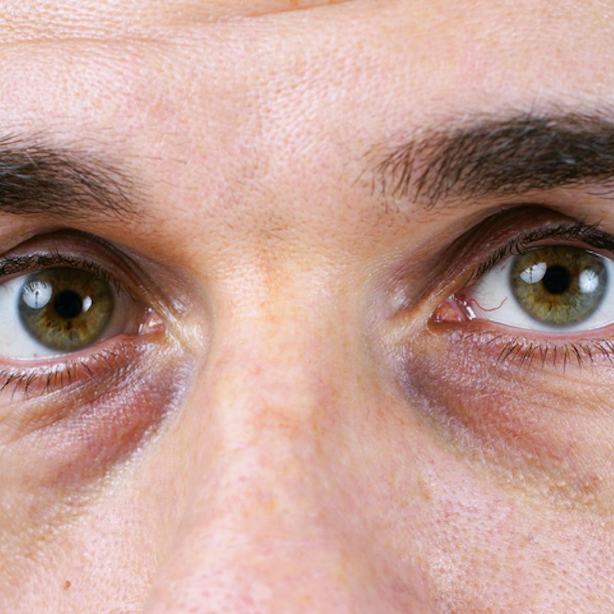 I Ve Always Wondered Why Do We Get Dark Circles Under Our Eyes