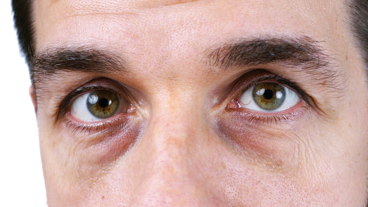 igennem Søgemaskine optimering jurist I've always wondered: why do we get dark circles under our eyes?