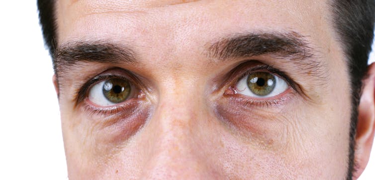QUESTION. The skin under our eyes is thinner than elsewhere on our face, meaning our blood vessels are more visible. Image from Shutterstock