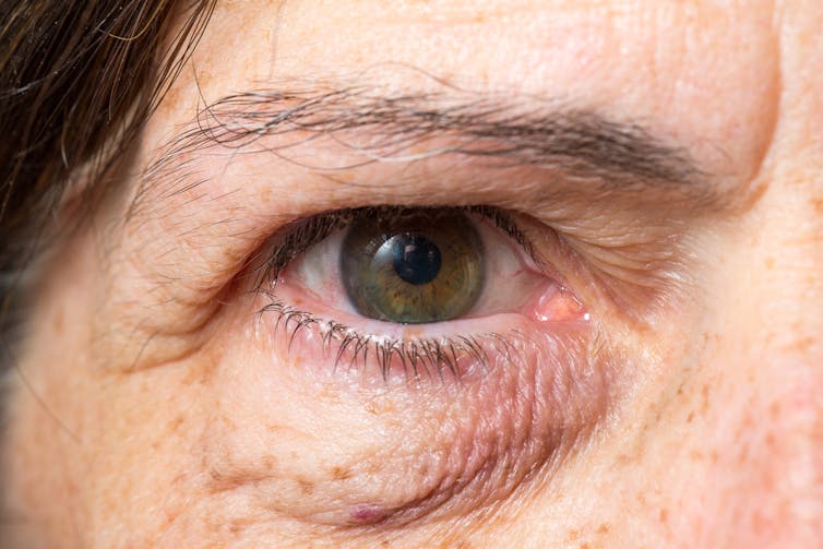 AGING PROCESS. It’s likely blood vessels under our eyes will become more visible as we age. from www.shutterstock.com