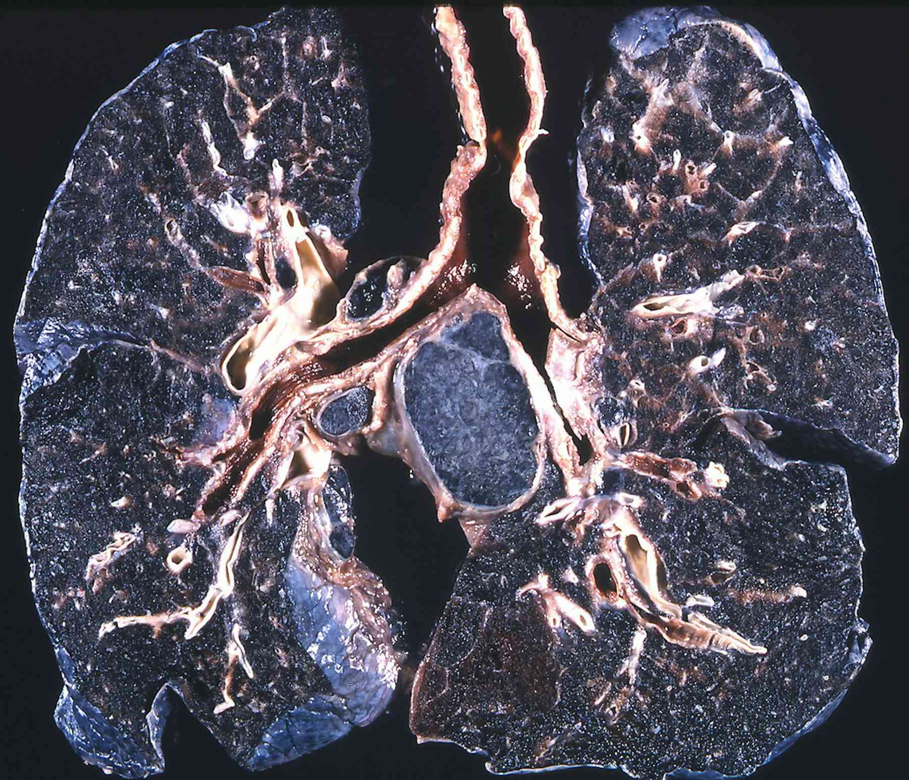 research papers on black lung disease