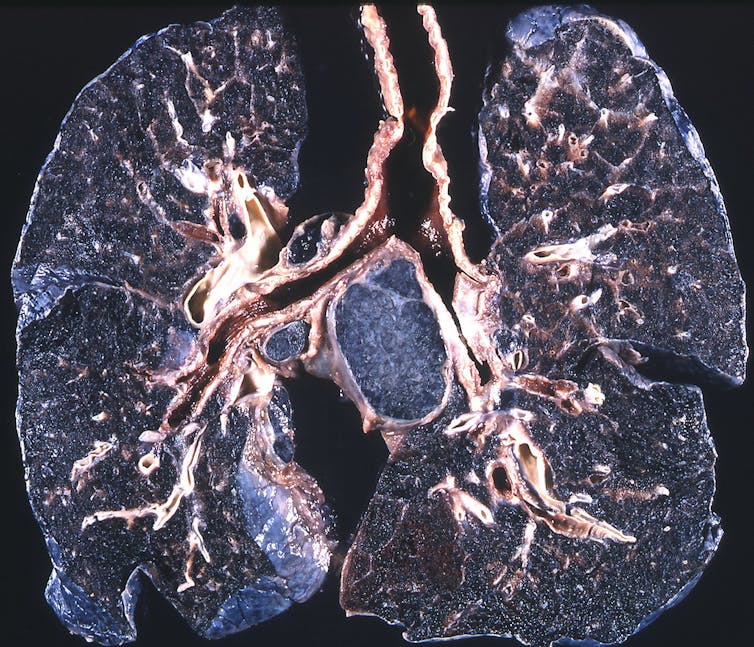 Black lung disease on the rise: 5 questions answered