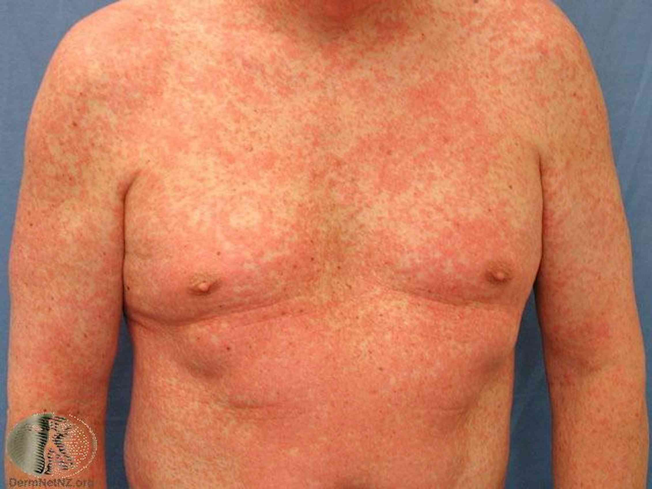 common-skin-rashes-and-what-to-do-about-them
