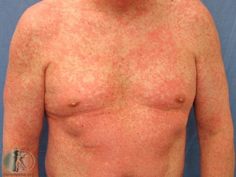 Why Did Older Man Develop Itchy, Full-Body Rash?