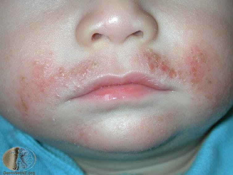 itchy rash on face