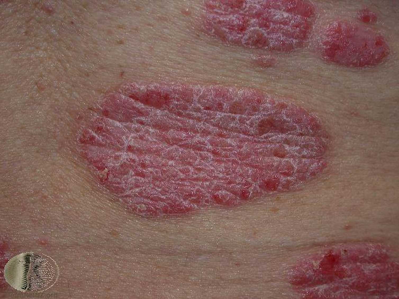 Common skin rashes and what to do about them