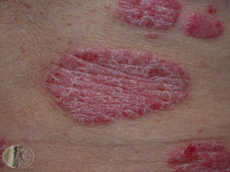 Common Skin Rashes And What To Do About Them