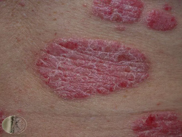 Pan Skin Rash Common skin rashes and what to do about them