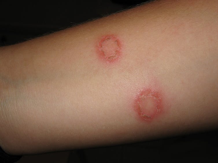 Common skin rashes and what to do about them