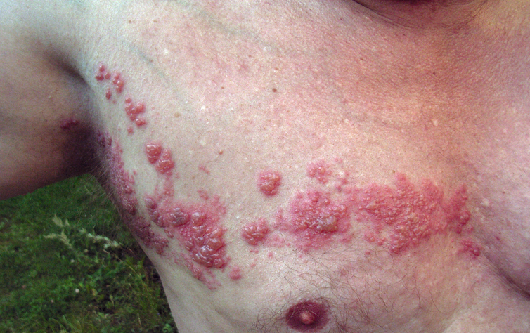 Common skin rashes and what to do about them