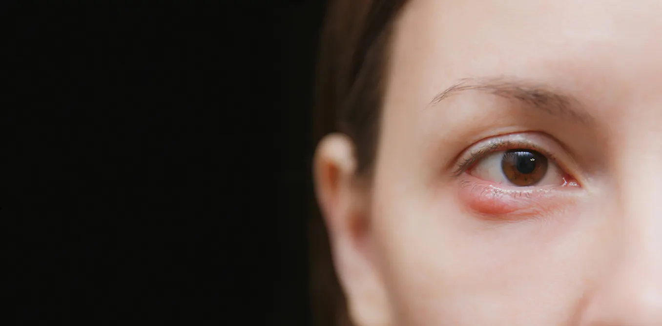 Sty Face Health Check: what caused my stye and can I get rid of it?