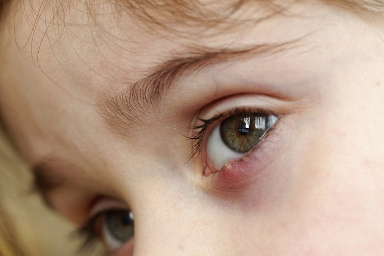 Health Check: What Caused My Stye And Can I Get Rid Of It?