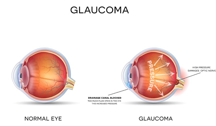 glaucoma