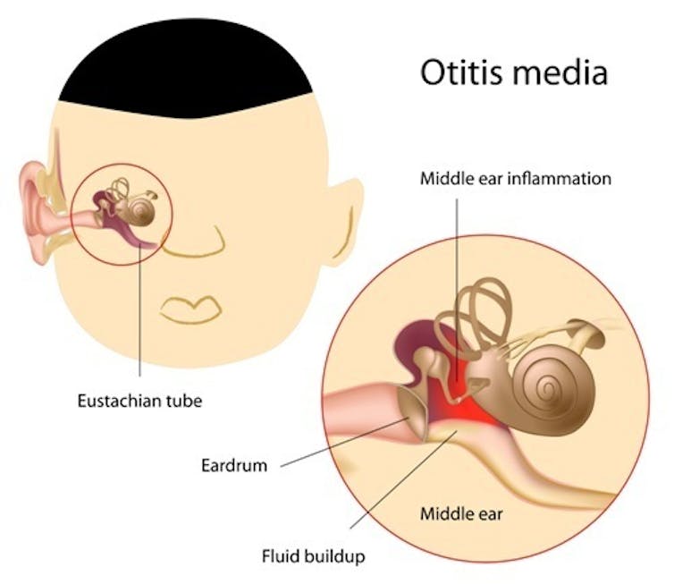 what are middle ear infections and how are they treated?