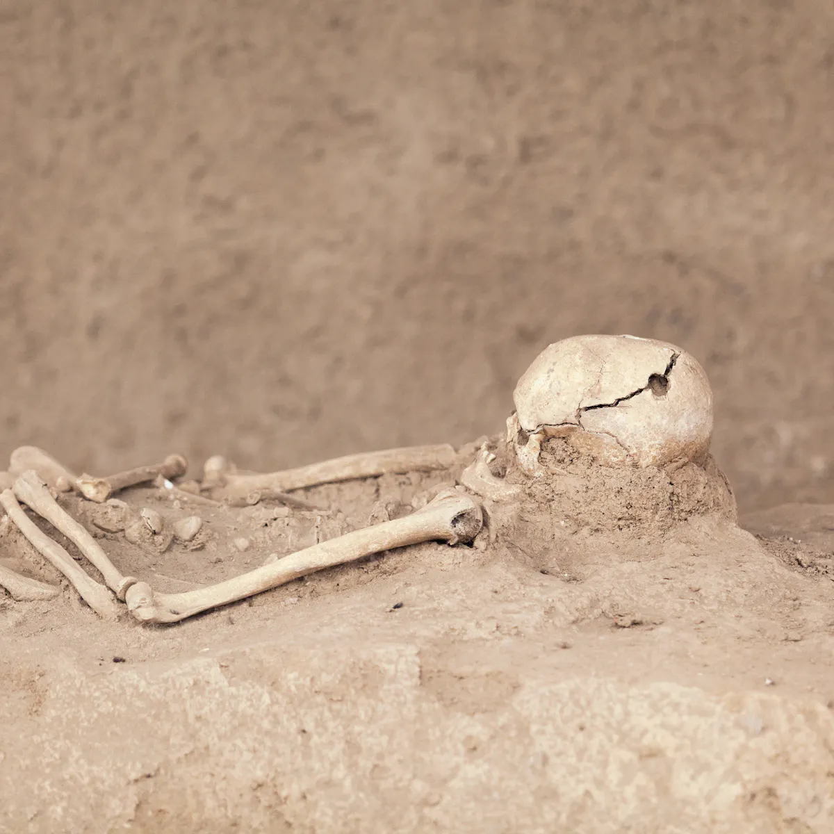 Drilling Holes In The Skull Was Never A Migraine Cure Here S Why It Was Long Thought To Be