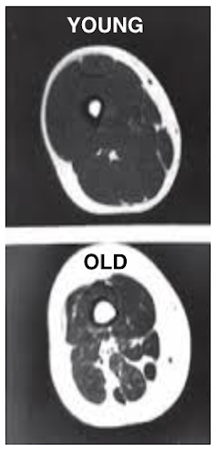 An MRI scan of the thigh: as people age, muscle mass declines and turns to fat. Janet Lord/University of Birmingham.