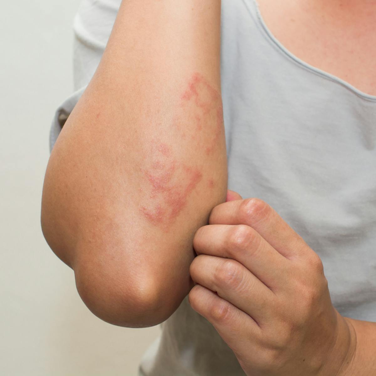 Common Skin Rashes And What To Do About Them