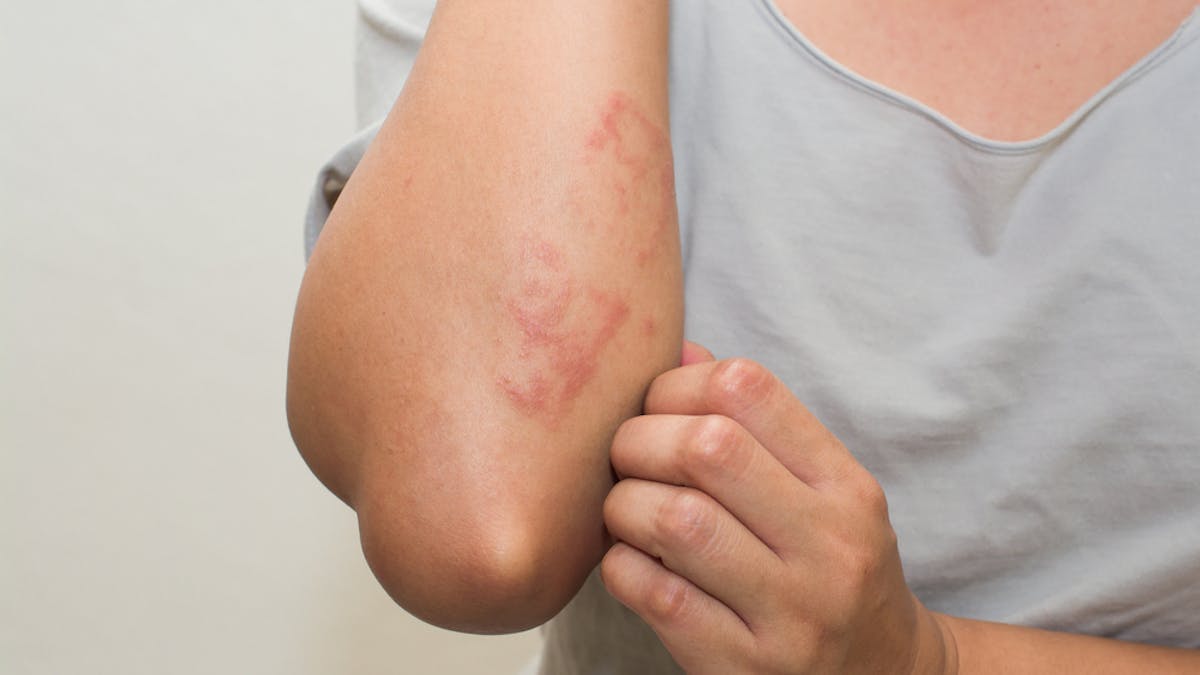 Common Skin Rashes And What To Do About Them