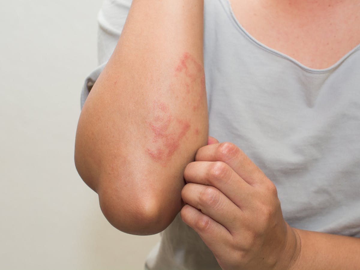 Common Skin Rashes And What To Do About Them