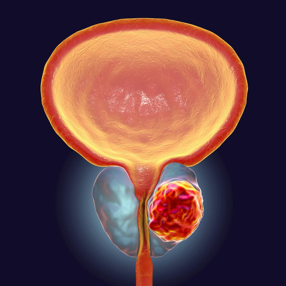 Psa Testing For Prostate Cancer Is Only Worth It For Some Psa Testing For Prostate Cancer Is Only Worth It For Some