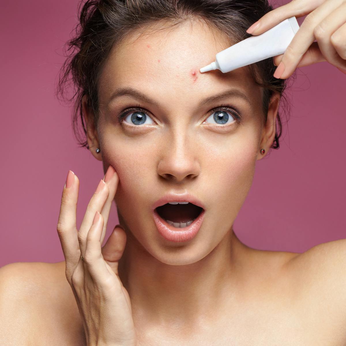 Why The Beauty Industry Will Never Fully Embrace Spots Scars And Pimples