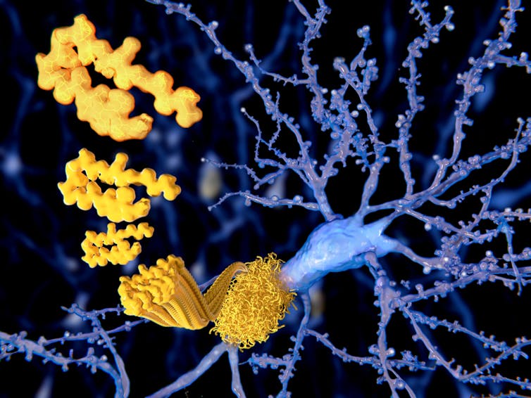 Plaques (in yellow) clumping on a neuron. (Juan Gaertner/Shutterstock)