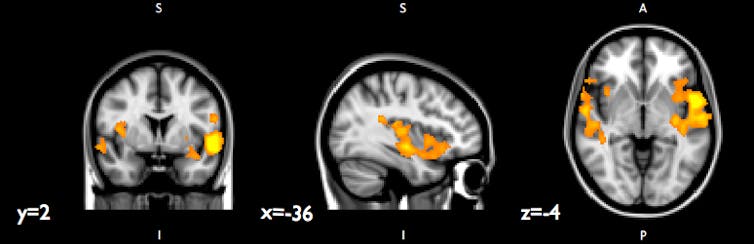 Living with neighborhood violence may shape teens' brains