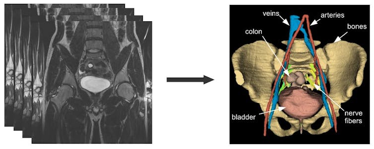 Exemple de modèle 3D du pelvis (droite) obtenu par traitement des images IRM (gauche).
