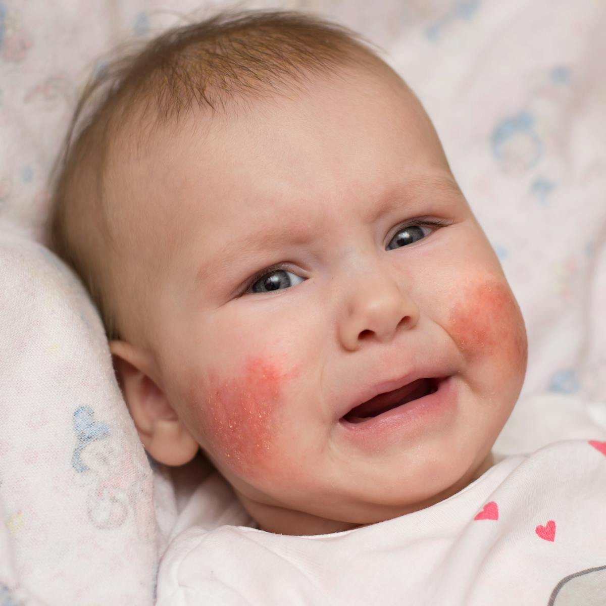 Applying Live Bacteria To Skin Improves Eczema Applying Live Bacteria To Skin Improves Eczema