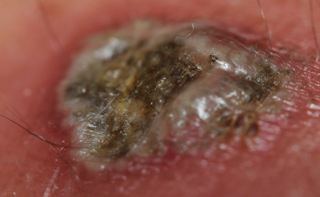 Science or Snake Oil: what is black salve and why do people think it can cure cancer? Science or Snake Oil: what is black salve and why do people think it can cure cancer?