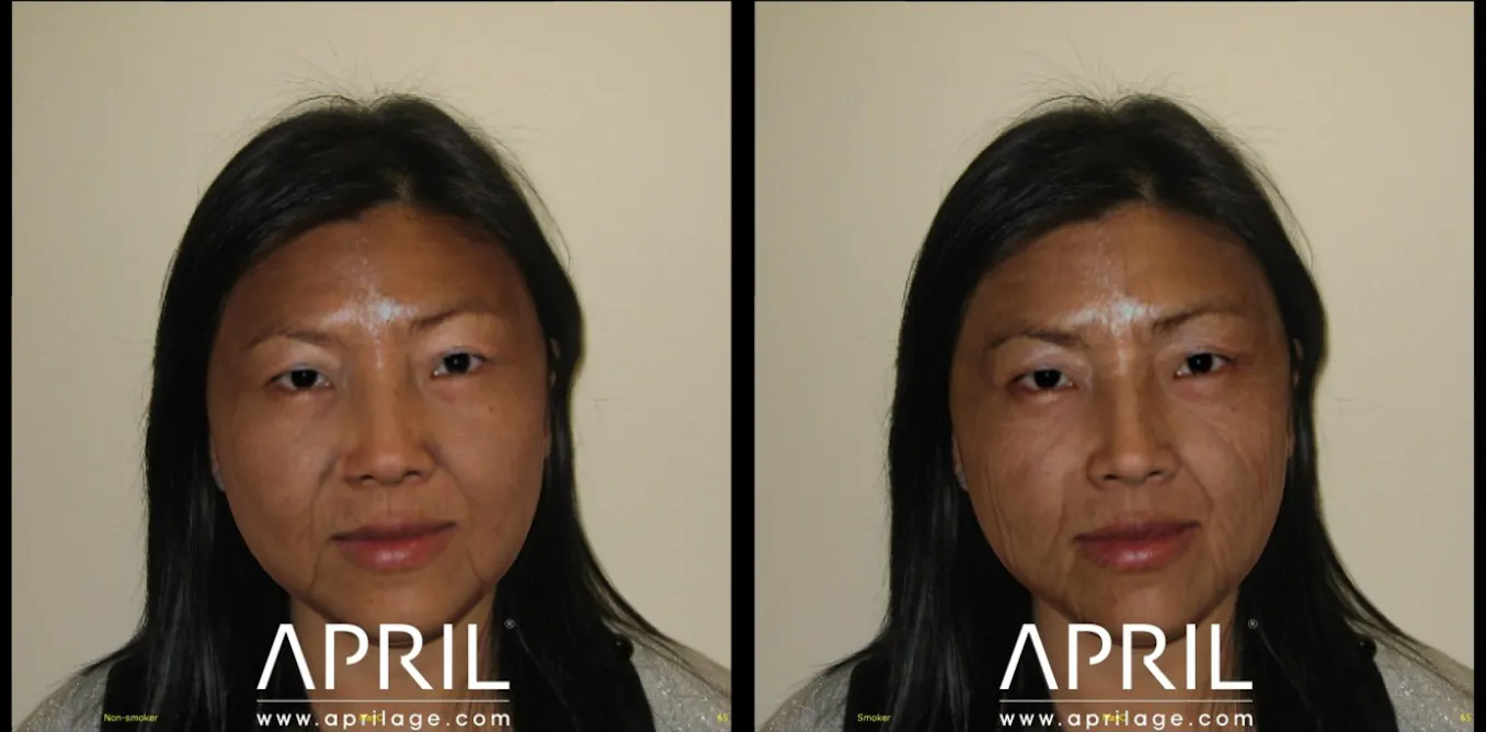 before and after smoking cigarettes Quitting improves your appearance by reducing the effects of premature ageing caused by toxins in tobacco smoke. Yvonne McWilliams used the help of our smoking cessation team to quit smoking Surprising Ways Smoking Affects Your