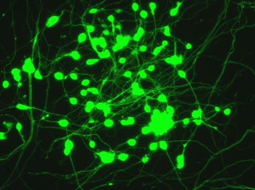 Neurons made from blood cells – a new tool for understanding brain diseases