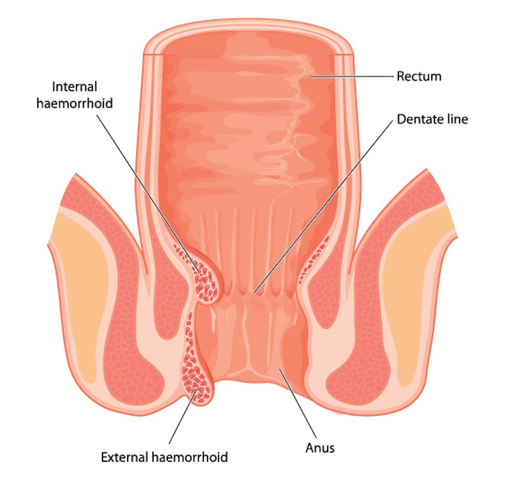 How do i know if i have hemorrhoids after pregnancy Explainer Why Do People Get Haemorrhoids And How Do You Get Rid Of Them