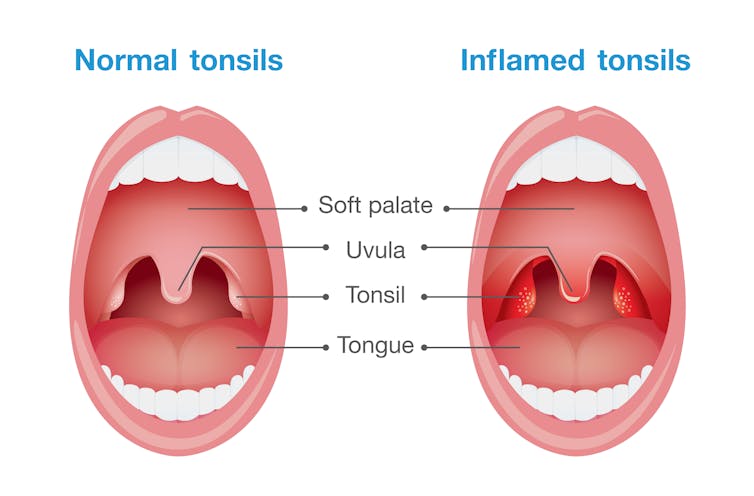 Why do we have tonsils?????