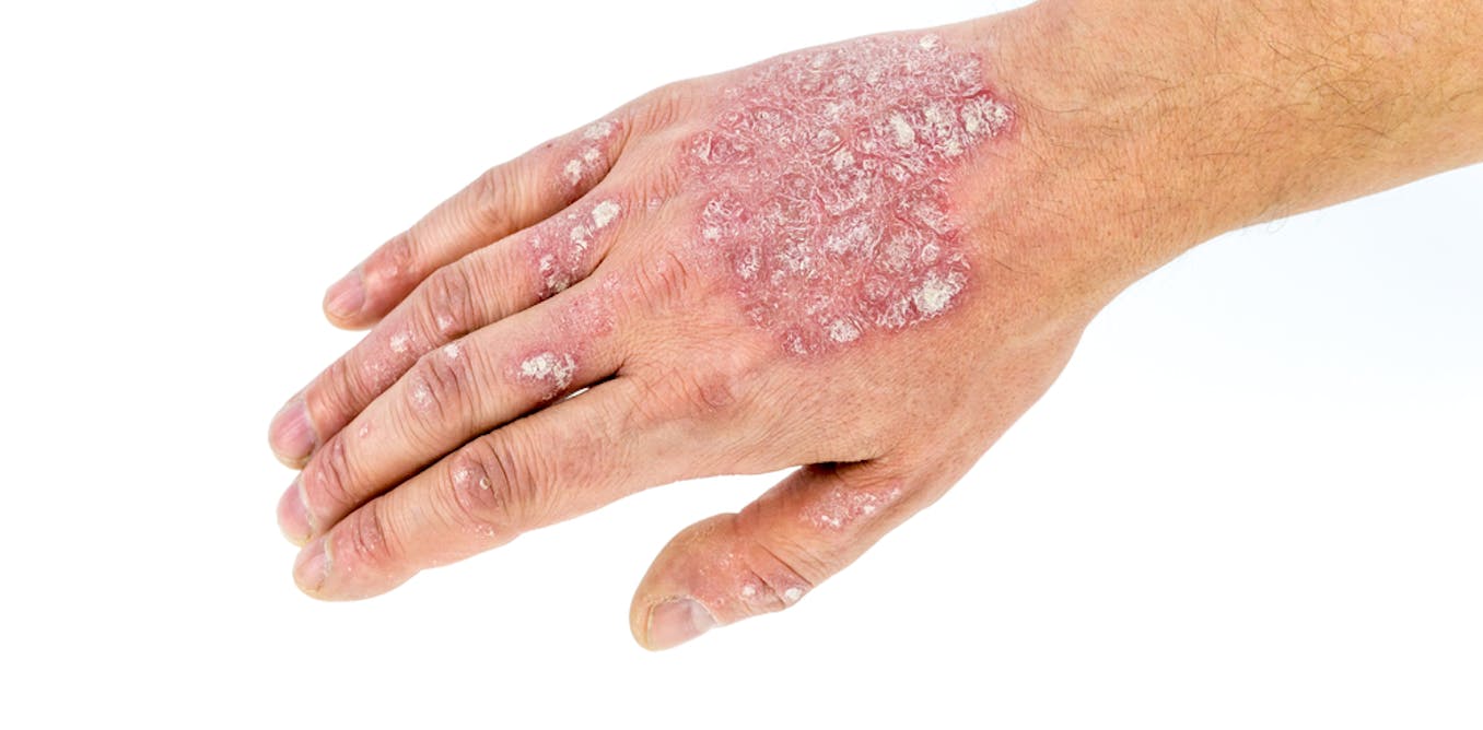Link between autoimmune disorders and psychosis confirmed in new study