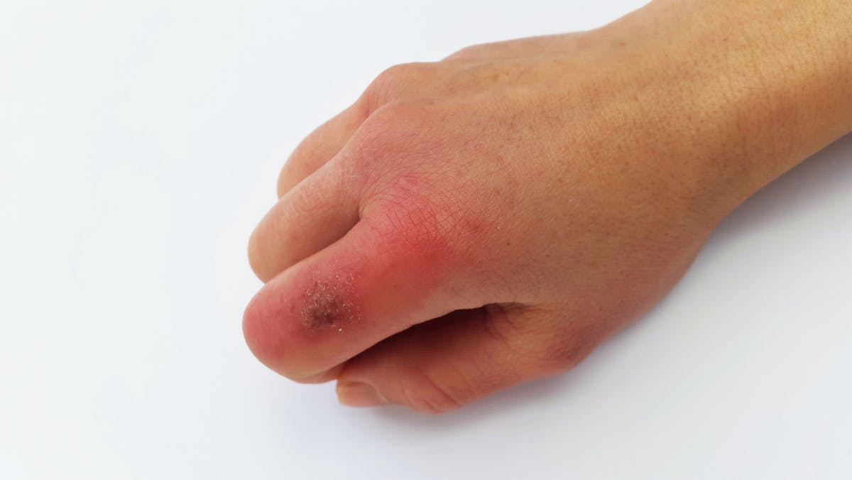 Check: what chilblains and how can I prevent them?
