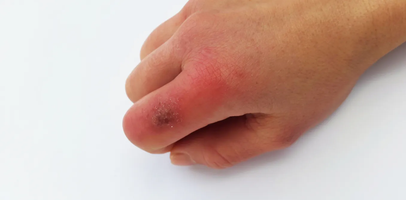 Red Itchy Bumps On Toes