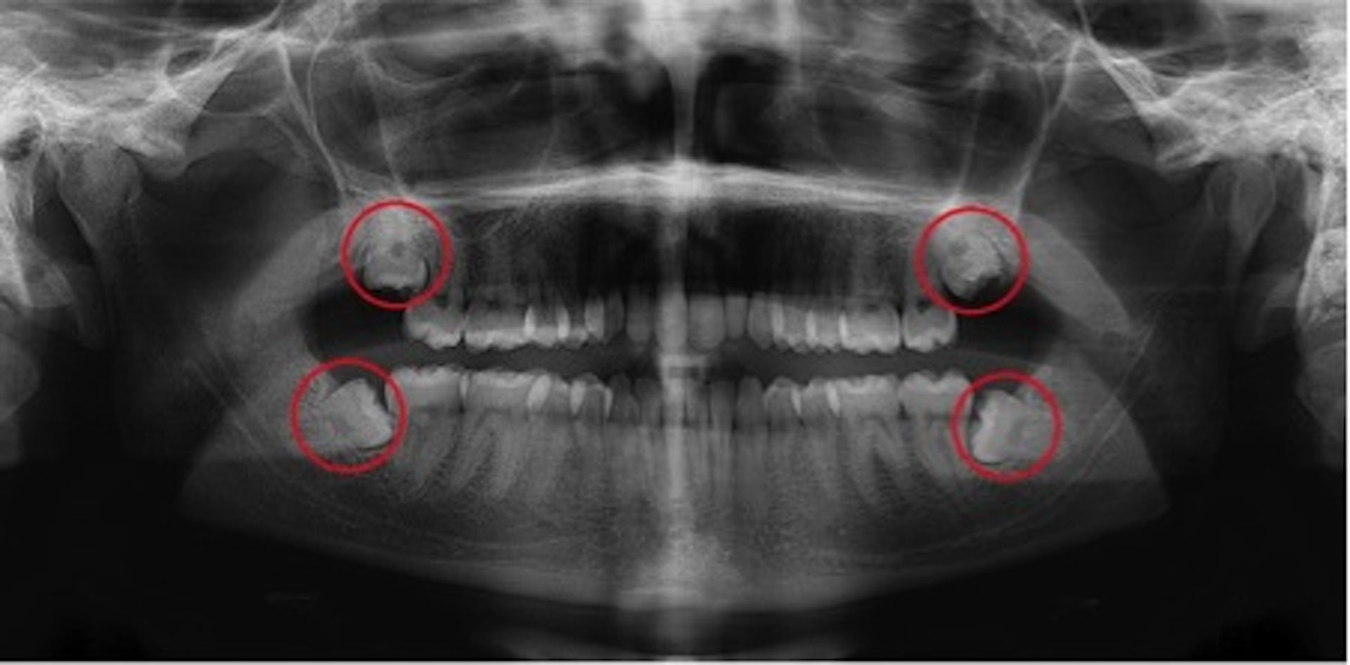 Explainer: What Are Wisdom Teeth And Should I Get Mine Out?