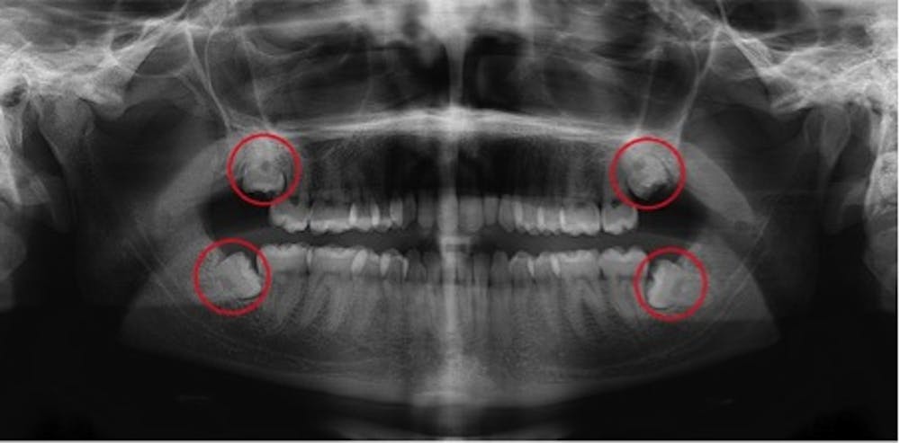 impacted molars signs extracting explainer gangguan mengalami sendi rahang полезна информация quadrant за