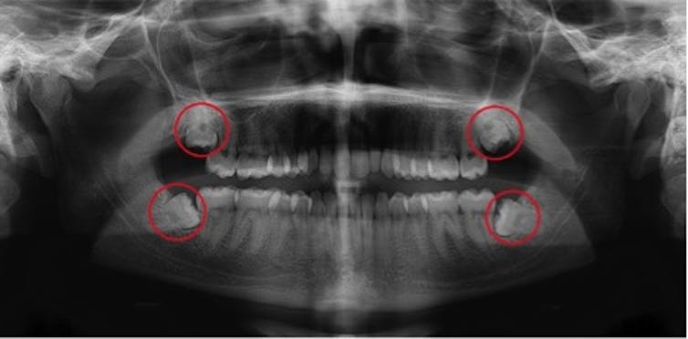what are wisdom teeth and should I get mine out?