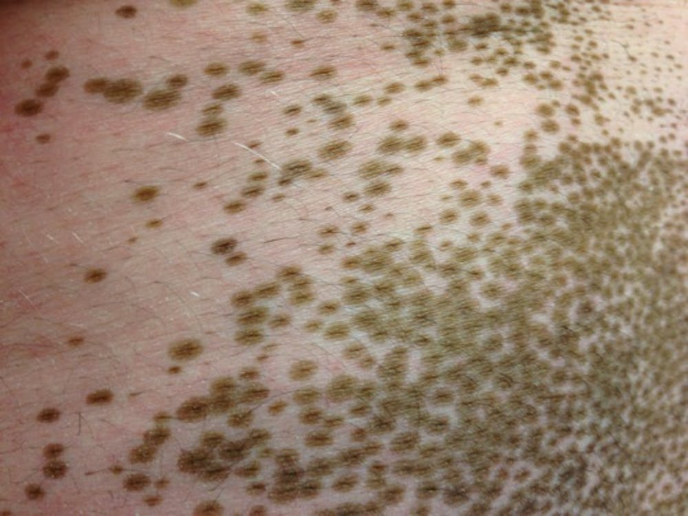 New Treatment In The Works For Disfiguring Skin Disease -